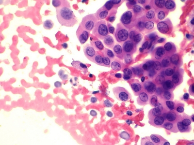 Hurthle cells (oncocytes).
Keywords: Hurthle Cell Adenoma, Folllicular Adenoma, Follicular Neoplasm