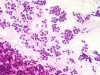 Follicular_neoplasm_hurthle_cell_type-fu_hurthle_cell_adenoma-H_E-low-sturgis.jpg