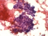 follicular_neoplasm_hurthle_cell_type-fu_hurthle_cell_carcinoma-pap14-high-sturgis.jpg