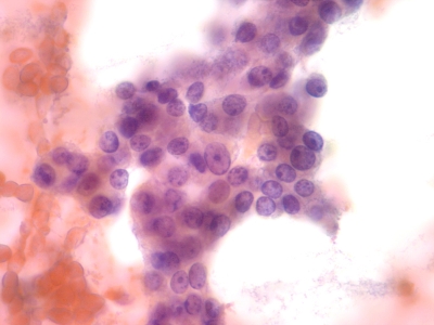 Hurthle Cell Neoplasm - Hurthle Cells - IMAGE ATLAS