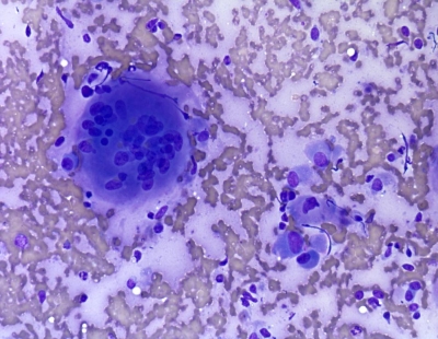 Malignant cells with an osteoclast-type giant cell.
Keywords: Undifferentiated, Anaplastic, Carcinoma