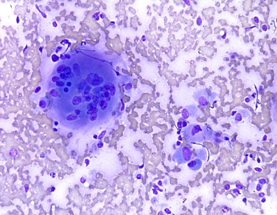 Anaplastic Carcinoma of Thyroid
A large inflammatory type giant cell found in a case of anaplastic carcinoma of the thryoid.
Keywords: Anaplastic Carcinoma
