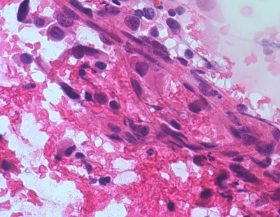 Malignant cells and blood (H&E).
Keywords: Undifferentiated, Anaplastic, Carcinoma