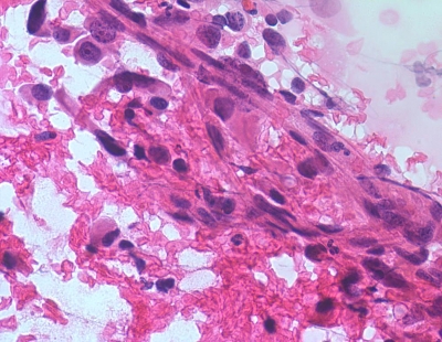 Anaplastic Carcinoma of Thyroid
Spindle cells in a portion of anaplastic carcinoma of thyroid.
Keywords: Anaplastic Carcinoma