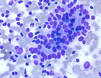 AUS/FLUS.
Follicular cells with crowding and pseudostratification are a prominent finding in this case of chronic lymphocytic thyroiditis (Bethesda monograph, pages 38-9: scenario 5).
Keywords: Chronic Lymphocytic Thyroiditis, Atypical Cells of Uncertain AUS in Hashimoto's Thyroiditis
