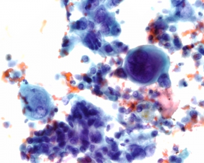 Anaplastic Carcinoma of Thyroid
Pap stained image with giant tumor cells
Keywords: Anaplastic Carcinoma