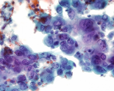 Malignant cells with extreme pleomorphism.
Keywords: Anaplastic Carcinoma