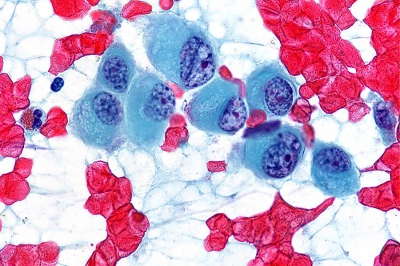 Large epithelioid malignant cells.
Keywords: Undifferentiated, Anaplastic, Carcinoma