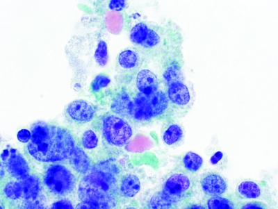 Some tumor cells appear glandular, with granular cytoplasm, round nuclei, and prominent nucleoli (ThinPrep).
Keywords: Primary Mucoepidermoid Carcinoma