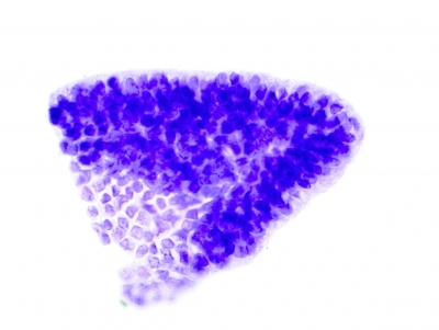 PTC, Columnar Cell Variant.
The cells are arrayed in a columnar ("picket fence") fashion along the edges of this crowded sheet.
Keywords: Papillary Carcinoma, liquid based, ThinPrep, Columnar Cell