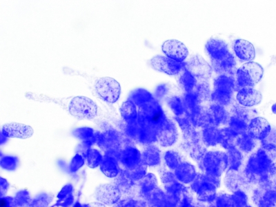 PTC, Columnar Cell Variant.
Columnar cells are clearly visible along the edge.
Keywords: Papillary Carcinoma, liquid based, ThinPrep, Columnar Cell
