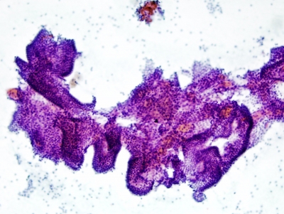 Benign follicular cells showing pseudopapillary hyperplasia.
Keywords: Papillary Hyperplasia, Benign Thyroid Nodule, Cell Block