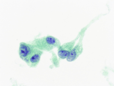 anaplastic Carcinoma of Thyroid in liquid base prep
Cells with variation in size and shape. Because of tendency of cells to round up in liquid preparations, cells much be evaluated in context of other cells present including inflammatory cells.
Keywords: anaplastic Carcinoma, liquid based preparation