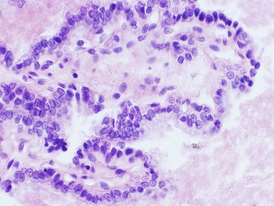 Hematoxylin and eosin-stained cell block section from a thyroidFNA.
Keywords: Papillary Carcinoma in Cell Block with Grooves