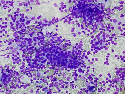 Polymorphous population of lymphocytes and Hurthle cells.
Keywords: Chronic Lymphocytic Thyroiditis (Hashimoto) Atypical Oncocytes