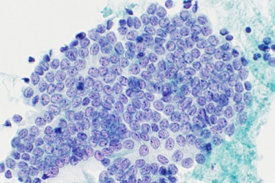 Monolayered sheet.
Keywords: Papillary Carcinoma, liquid based, ThinPrep