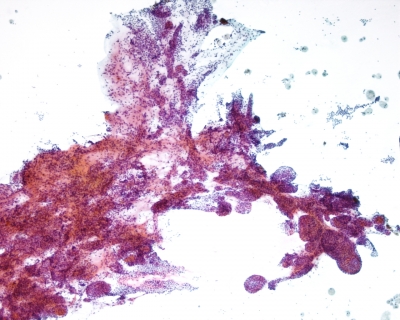 Benign follicular cells with pseudopapillary hyperplasia.
Keywords: Papillary Hyperplasia, Benign Thyroid Nodule, Benign Follicular Cells