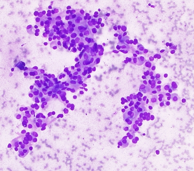 Papillary Carcinoma Follicular Variant
Intermediate power image of papillary carcinoma, some micro acini are present. Note the variation in nuclear profiles. This is a biopsy proven follicular variant of papillary carcinoma.
Keywords: Papillary Carcinoma, Follicular Variant