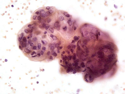 Follicular cells with elongated nuclei embedded in stroma. (Histologic follow-up revealed a hyalinizing trabecular adenoma.)
Keywords: Hyalinizing Trabecular Adenoma, Histology
