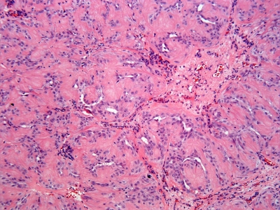 The hyalinizing trabecular adenoma resembles papillary thyroid carcinoma. Note, however, that the elongated nuclei  are almost spindle shaped and the cells are embedded within stroma (histologic section).
Keywords: Hyalinizing Trabecular Adenoma, Histology