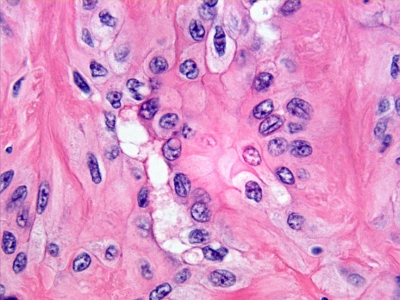 Histologic view of a hyalinizing trabecular adenoma (high magnification).
Keywords: Hyalinizing Trabecular Adenoma, Histology