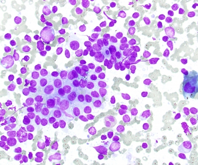 Hashimotos follicular cells and mixed lymphocyte population
Hashimotos follicular cells and mixed lymphocyte population
Keywords: Hashimoto's, Intermediate, Chronic Lymphocytic Thyroiditis