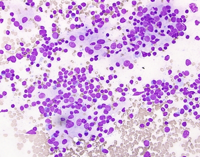 Hashimotos, germinal center material High Power
At high power this image demonstrates a polymorphous population of lymphoid and monocytic cells characteristic of the cells found in a germinal center. Germinal centers are frequently found amid the lymphoid aggregates present in Chronic Lymphocytic Thyroiditis.
Keywords: Germinal Center, Chronic Lymphocytic Thyroiditis (Hashimoto's)