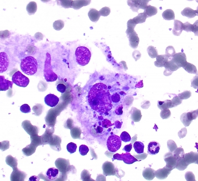 Tingible Body Macrophage in Hashimoto's Thyroiditis
Classic Tingible Body macrophage. Particulate material in macrophage cytoplasm secondary to phagocytic action.
Keywords: Tingible Body Macrophage Hashimoto's Thyroiditis