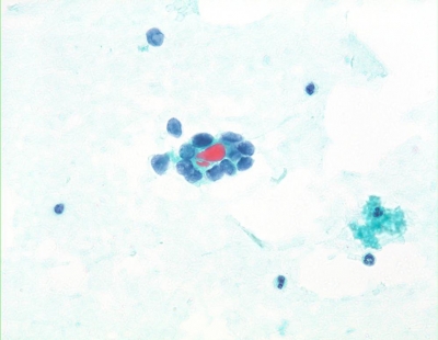 Poorly Differentiated Carcinoma (Insular Carcinoma).
Acinar or microfollicular arrays are often seen.
Keywords: Insular Carcinoma, Poorly Differentiated Carcinoma