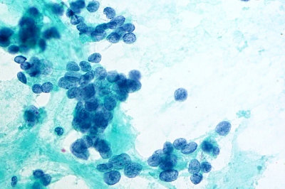 Poorly Differentiated Carcinoma (Insular Carcinoma).
Overlapping cells with granular chromatin may have nuclear grooves.
Keywords: Insular Carcinoma, Poorly Differentiated Carcinoma