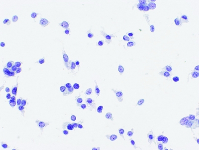 Poorly Differentiated Carcinoma (Insular Carcinoma).
Isolated malignant cells (ThinPrep®).
Keywords: Insular Carcinoma, Poorly Differentiated Carcinoma
