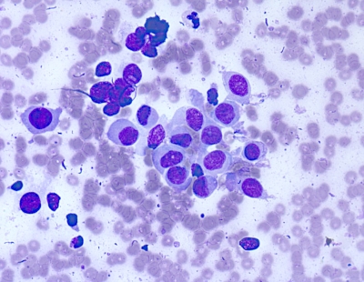 Few scattered plasmacytoid cells. (Histologic follow-up: Langerhans cell histiocytosis).
Keywords: Suspicious for Medullary Carcinoma Langhans Cell Histocytosis