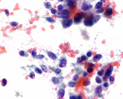 Suspicious for medullary carcinoma - Sparsely cellular sample with ...