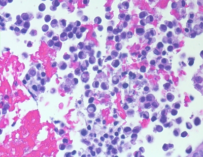 Metastatic gastric signet ring cell carcinoma (cell block).
Keywords: Metastatic Gastric Signet Ring Carcinoma Cell Block