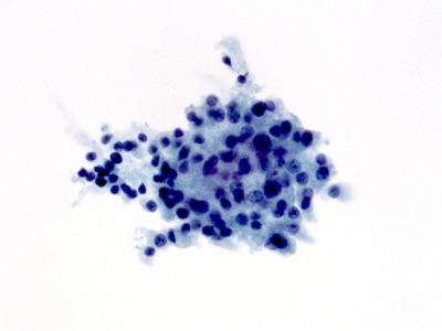 Poorly Differentiated Carcinoma (Insular Carcinoma).
Keywords: Poorly Differentiated Carcinoma, Insular Carcinoma