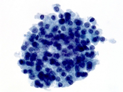 Poorly Differentiated Carcinoma (Insular Carcinoma).
Keywords: Poorly Differentiated Carcinoma, Insular Carcinoma