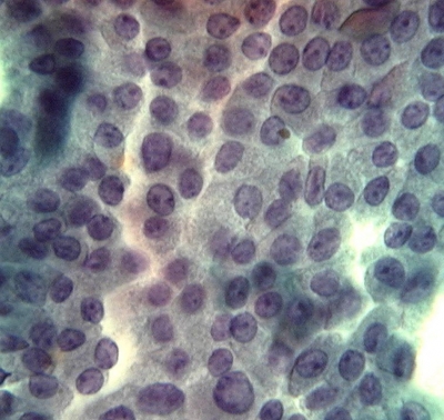 Papillary Carcinoma of Thyroid - Tall Cell Variant
The oncocytic cytoplasm and prominent nucleoli of the tall cell variant impart a resemblance to oncocytic follicular tumors (Hurthle cell tumors). The other nuclear features of papillary carcinoma should be readily found.
Keywords: Papillary Thyroid Carcinoma, Tall Cell Variant (PTC TCV): 