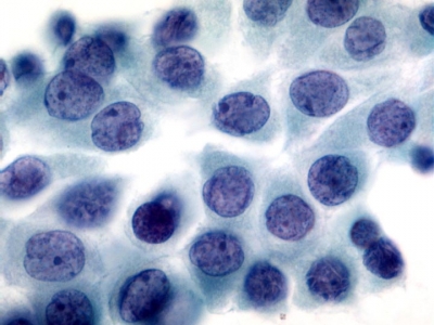 Papillary Carcinoma of Thyroid - Tall Cell Variant
Oval and irregular nuclei are typical of papillary thyroid carcinoma.
Keywords: Papillary Thyroid Carcinoma, Tall Cell Variant (PTC TCV): 