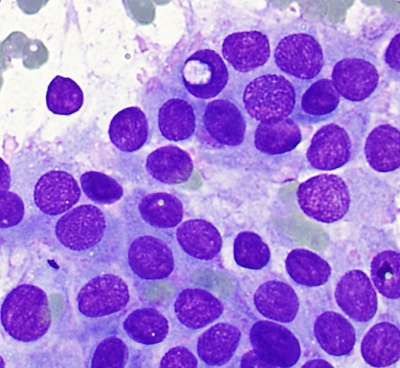 Papillary Carcinoma with Inclusion
Keywords: INCI inclusion  Papillary Carcinoma Malignant 