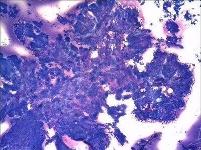 Anastomosing true papillae.
Keywords: Papillary Carcinoma, Classic, Papillae