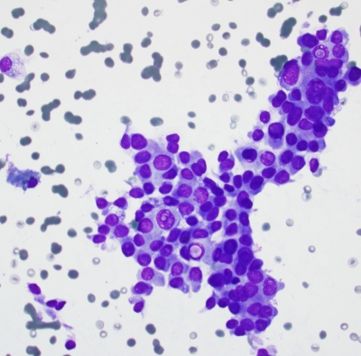 Papillary Carcinoma
From Cystic type papillary carcinoma 
Keywords: Papillary Carcinoma, Nuclear Inclusion