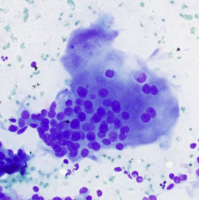 Multinucleated giant cell in papillary carcinoma
These inflammatory type giant cells are sometimes seen in papillary carcinoma
Keywords: Giant Cell Papillary Carcinoma