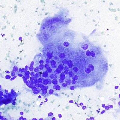 Giant Cell in Papillary Carcinoma
Giant cell image from papillary carcinoma
Keywords: Giant_Cell