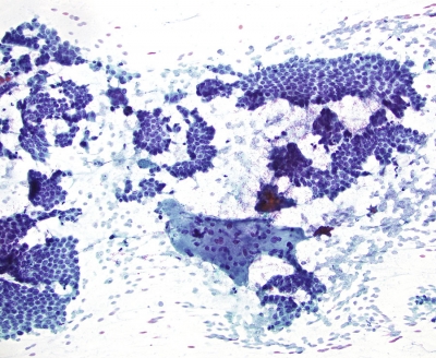 Papillary Carcinoma high cellularity and giant cell
Low power image of papillary carcinoma with multinucleated giant cell
Keywords: Papillary _Carcinoma cellularity low_power Giant_Cell