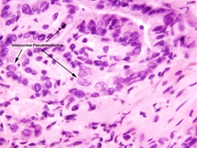 Papillary Carcinoma of Thyroid-Frozen Section
Intranuclear Pseudoinclusions.
Keywords: Papillary Carcinoma, Frozen Section, Pseudoinclusions