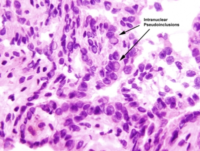Papillary Carcinoma of Thyroid-Frozen Section
Keywords: Papillary Carcinoma, Frozen Section