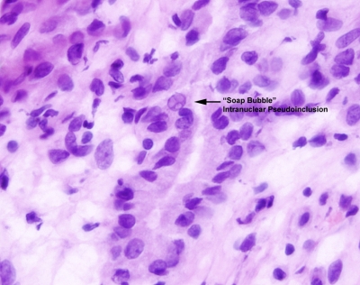 Papillary Carcinoma of Thyroid-Frozen Section
Keywords: Papillary Carcinoma, Frozen Section