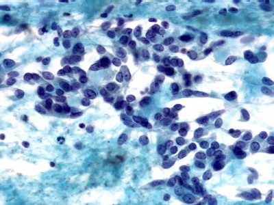 Epithelioid and fusiform (spindle-shaped) cells.
Keywords: Medullary Carcinoma, Spindle Cell