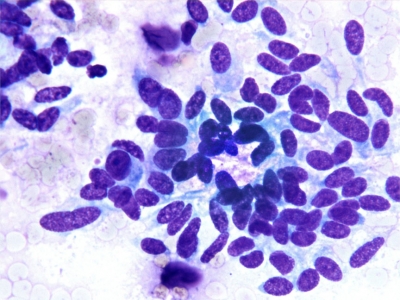 Medullary Thyroid Carcinoma - Relatively monomorphic fusiform cells and ...