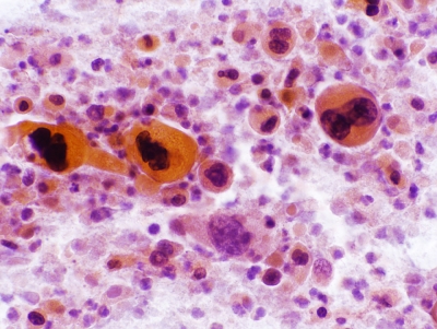 Squamous Cell Carcinoma of the Thyroid.
Keratinizing malignant cells with necrosis.
Keywords: Squamous Cell Carcinoma, Keratinizing